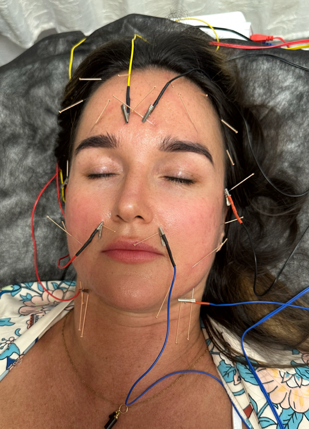 Neurolifting